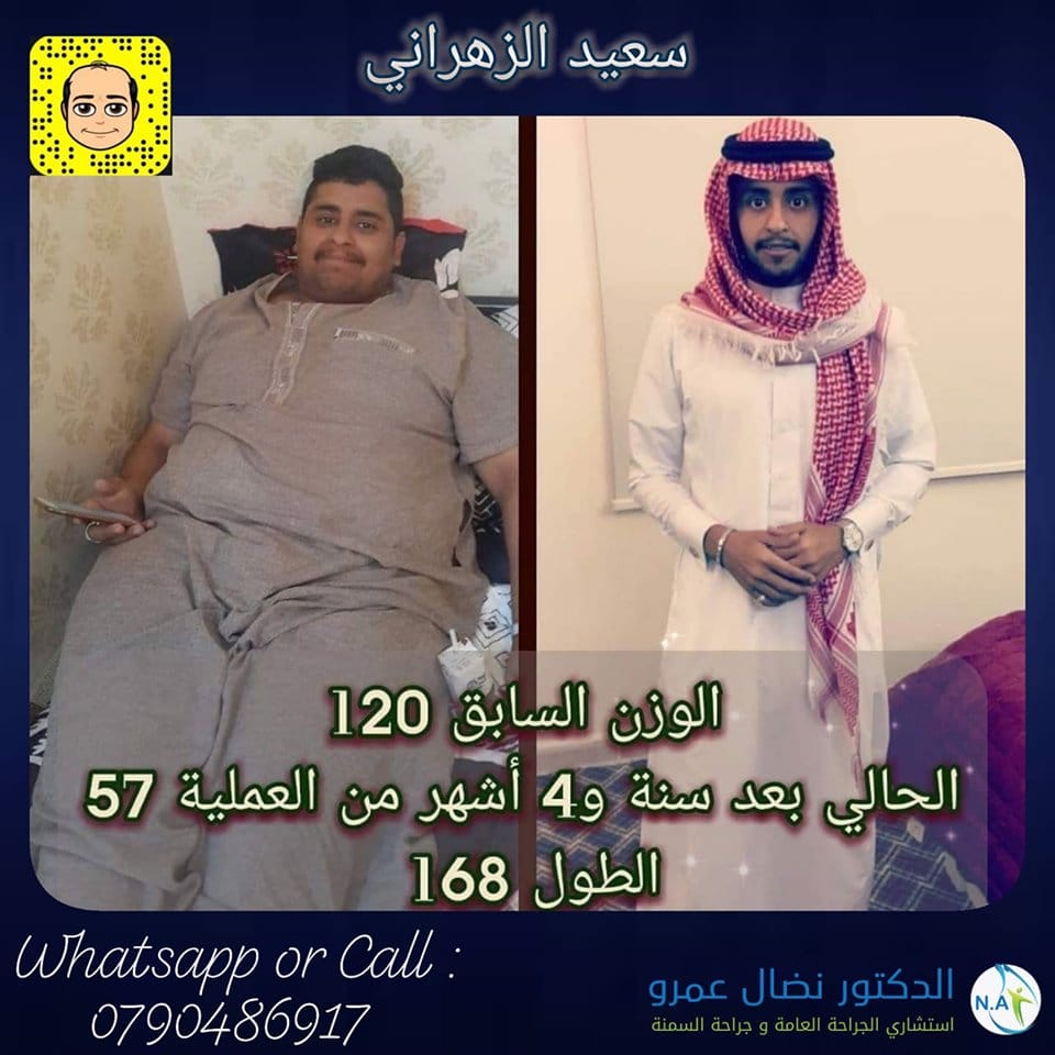 عملية تكميم المعدة الدكتور نضال عمرو عملية تكميم المعدة الدكتور نضال عمرو
