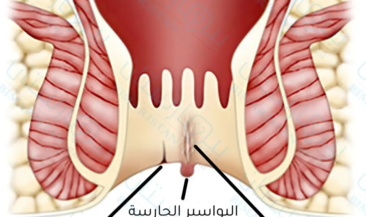 أسباب الشق الشرجي